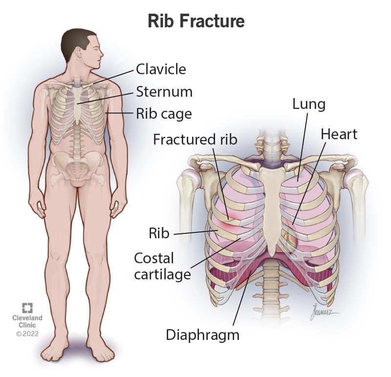 What Is The Primary Symptom Of Fractured Ribs Painful Reality