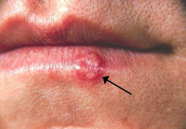 can-herpes-spread-while-dormant-uncovering-facts