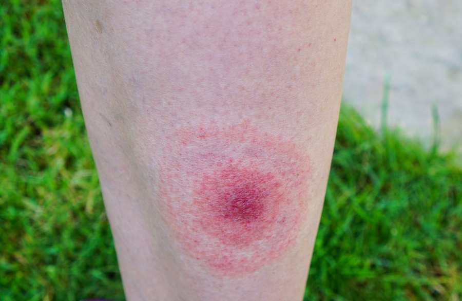 Should I Be Worried About A Tick Bite Essential Insights