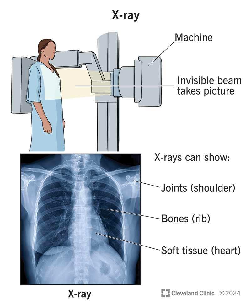 Does X Ray Show Arthritis? 