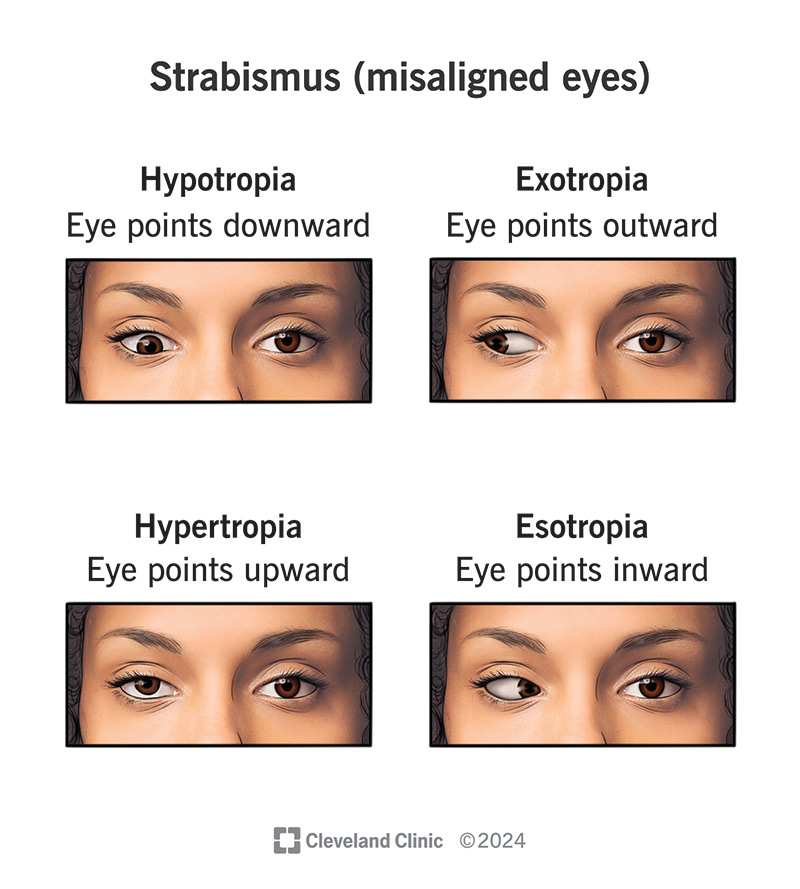 How Many People Can Cross Their Eyes? 