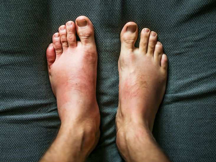 what-does-feet-swelling-mean-understanding-causes