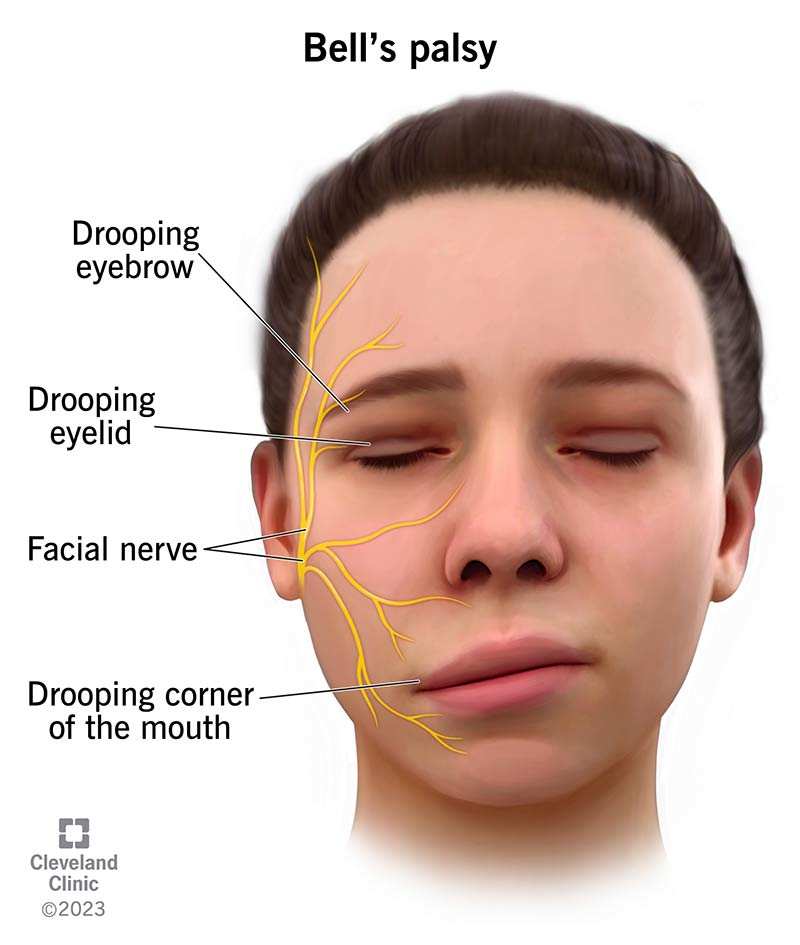 What Causes Bell's Palsy In Men? 